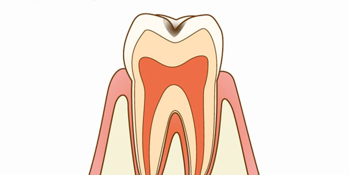 C1：エナメル質内の虫歯