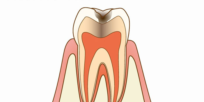 C2：象牙質に達した虫歯