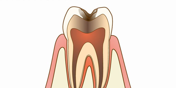 C3：歯髄(神経)に達した虫歯 