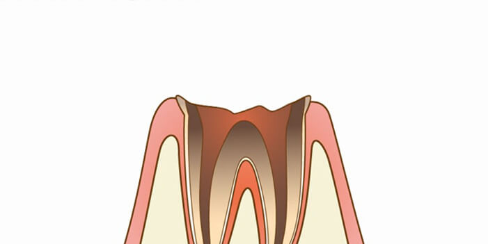 C4：歯質が失われた虫歯