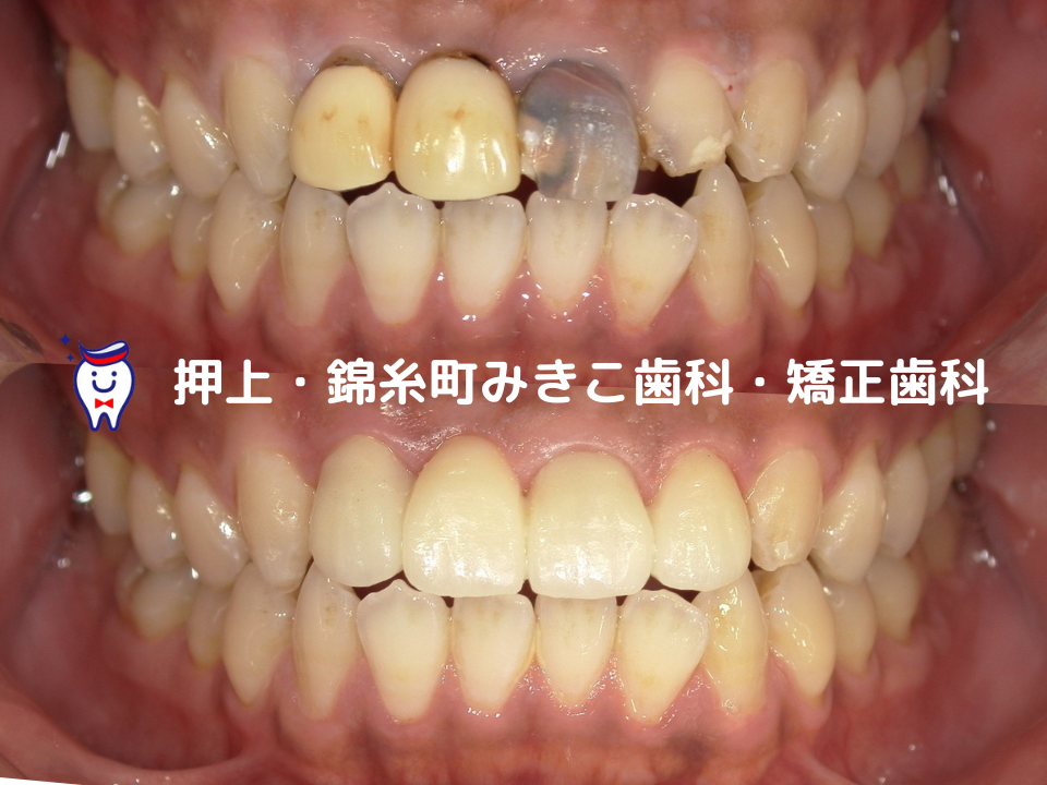 押上・錦糸町みきこ歯科・矯正歯科セラミック症例画像